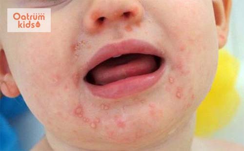  Bé bị tay chân miệng phải làm sao