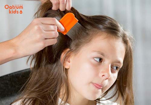  Chải lược bí trong vòng 20 phút cho trẻ bị chấy rận