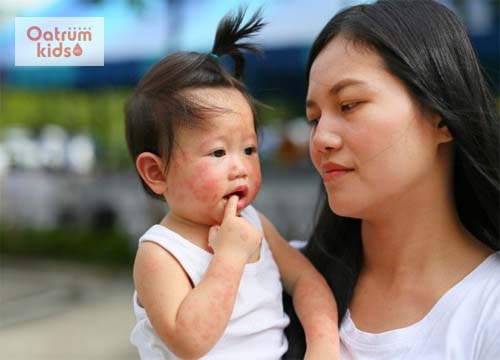 Bệnh tay chân miệng ở trẻ em cần kiêng gì ?