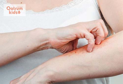 Ghẻ nước gây ngứa ngáy, khó chịu