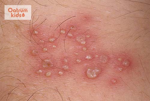 Bệnh giời leo có lây không