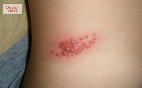  Bệnh giời leo ở trẻ em