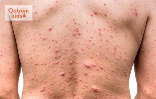 Biểu hiện của bệnh phỏng dạ với những tồn thương nhiều độ tuổi.