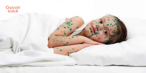  Bệnh phỏng dạ tắm lá gì để mau khỏi?