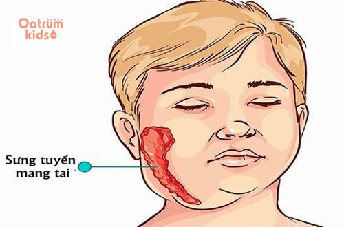  Bệnh quai bị gây sưng tuyến mang tai