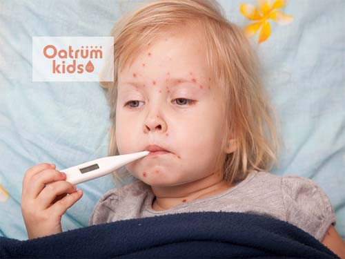  Bệnh sởi ở trẻ em có thể gây ra nhiều biến chứng nguy hiểm