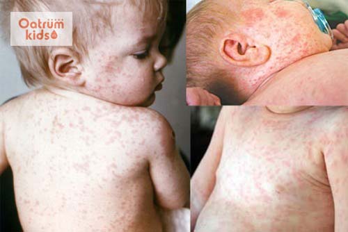  Trẻ mọc ban sởi khắp người khi bệnh tiến triển