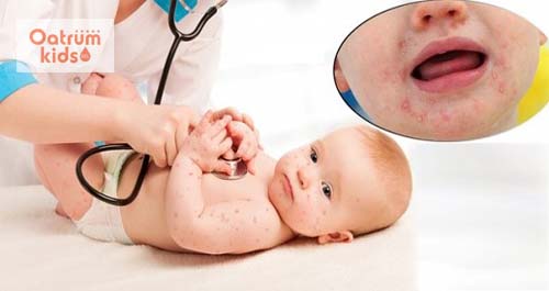  Bệnh tay chân miệng gây ra nhiều biến chứng nguy hiểm