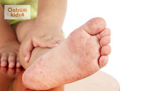  Gây ra những nốt ban đỏ tại các vị trí như lòng bàn chân, bàn tay, trong miệng…