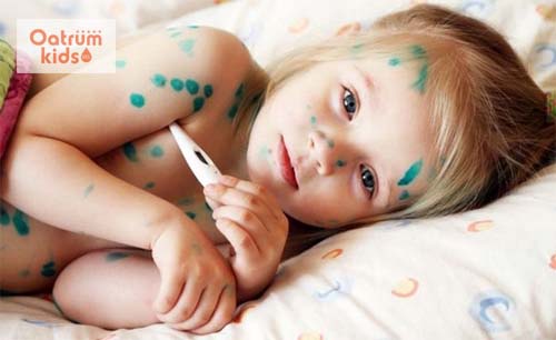  Cần vệ sinh tổn thương để tránh trẻ bị bội nhiễm giai đoạn thoái trào