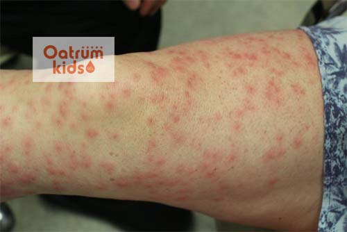  Biểu hiện bệnh viêm da tiếp xúc