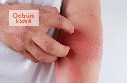  Không nên gãi dẫn đến tình trạng bệnh nặng hơn và có thể để lại sẹo