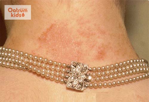  Viêm da dị ứng do đeo trang sức