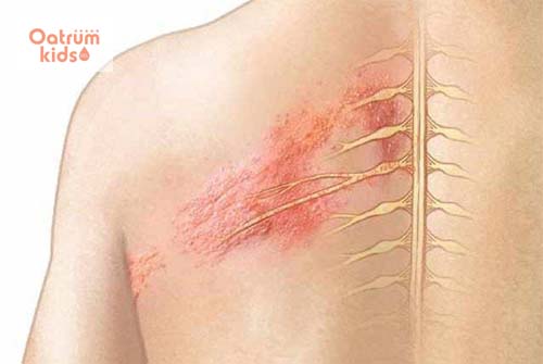  Bệnh zona có lây không?