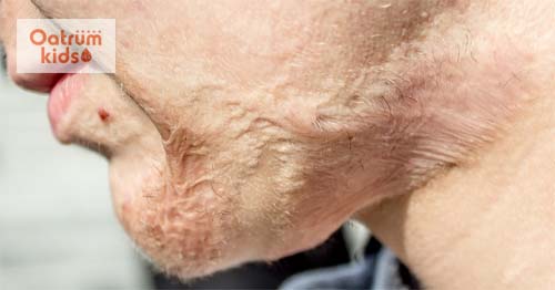 Sẹo bỏng thường để lại sau một thời gian dài sau khi lành vết thương