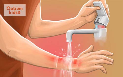 Sơ cứu vết bỏng đúng cách