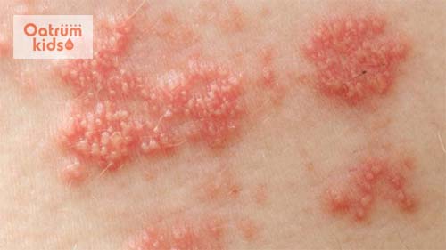 Biểu hiện của bệnh zona trên da