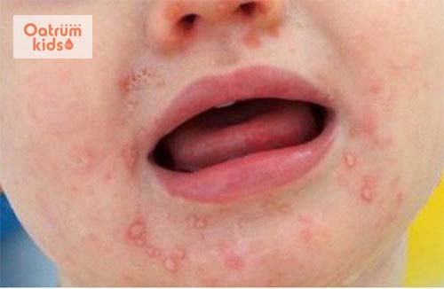  Biểu hiện bệnh tay châm miệng ở trẻ nhỏ