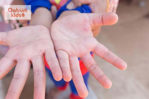  Bệnh chân tay miệng do virus gây ra