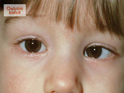  Trẻ bị lé, lác mắt có thể dẫn đến nguy cơ nhược thị