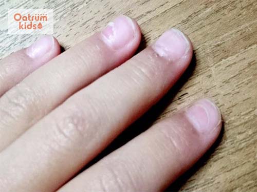  Nấm móng tay là bệnh trẻ em thường mắc phải
