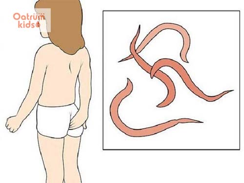  Nhiễm giun kim chủ yếu ở trẻ em từ 5 đến 12 tuổi