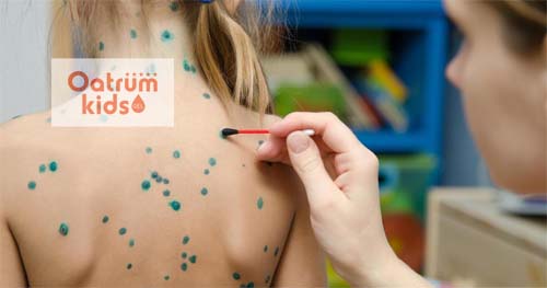  Tìm hiểu cách bôi xanh methylen đúng cách giúp bệnh khỏi nhanh hơn