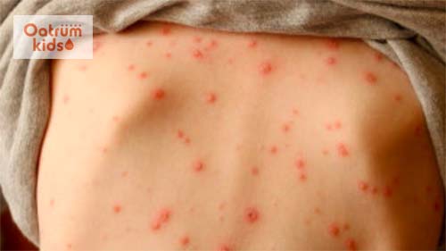  Chỉ bôi xanh methylen khi các nốt phỏng nước tự vỡ