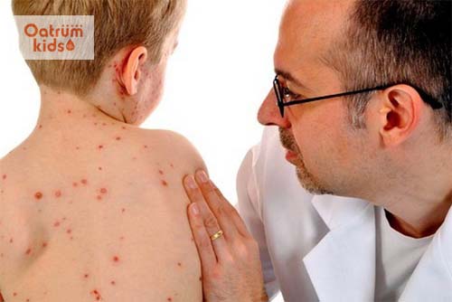  Nhận biết dấu hiệu thủy đậu từng giai đoạn chính xác bôi xanh methylen thủy đậu hiệu quả 