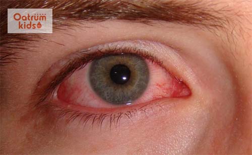 Người bệnh có thể dùng một số bài thuốc nam khi bị bệnh đau mắt đỏ thể nhẹ