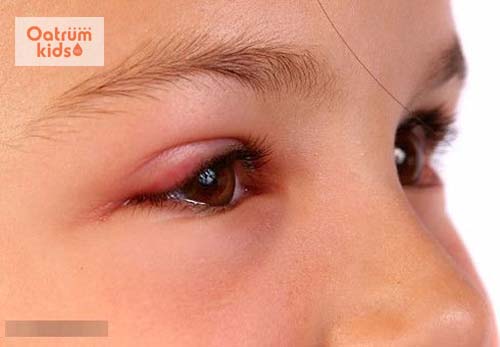 Lẹo mắt là một căn bệnh phổ biến ở Việt Nam