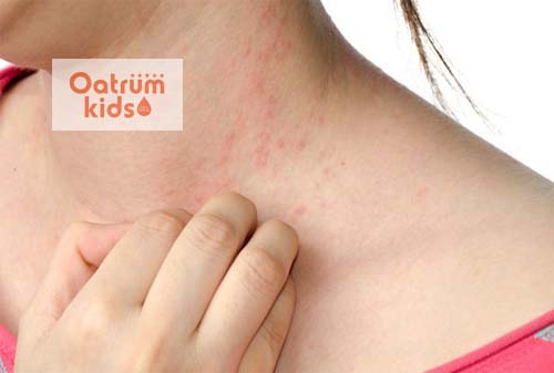  Không được gãi khi bị phỏng dạ