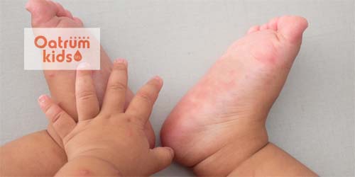  Cách điều trị bệnh chân tay miệng tại nhà