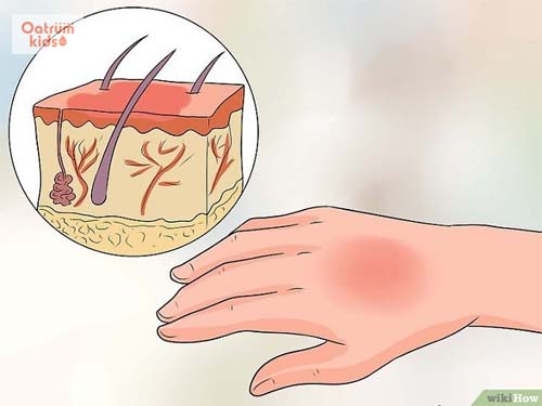  Bỏng được chia thành 3 mức độ khác nhau