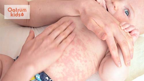  Triệu chứng nổi mề đay buổi tối là da sần, phù, ngứa dữ dội