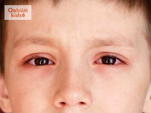  Mắt đỏ và có ghèn là những dấu hiệu đầu tiên của bệnh đau mắt đỏ