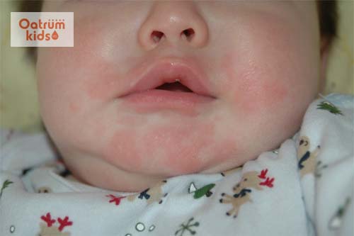 Dị ứng thời tiết ở trẻ em