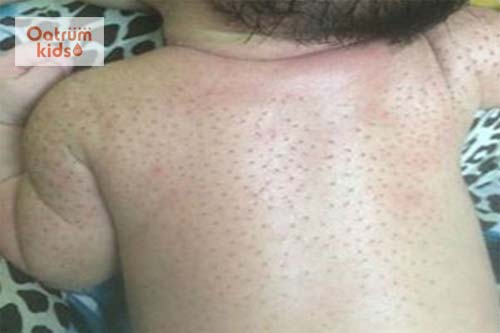 Lông đẹn ở trẻ sơ sinh là tình trạng bình thường