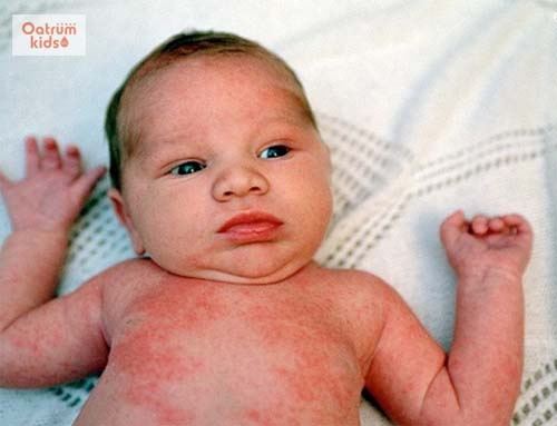  Trẻ em rất hay bị mề đay do sức đề kháng còn quá yếu