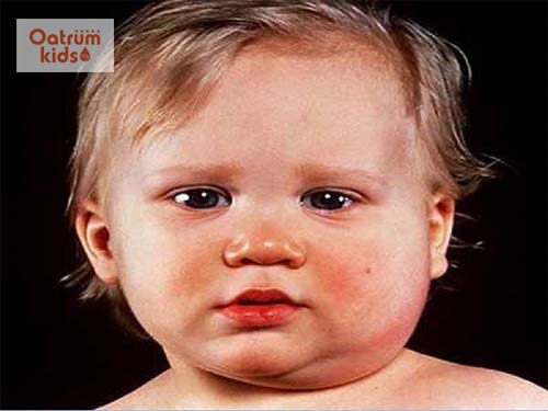 Quai bị có thể dẫn đến nhiều biến chứng nguy hiểm