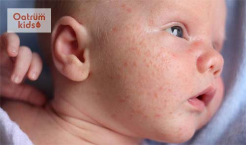 Có nhiều nguyên nhân dẫn đến lác sữa ở trẻ