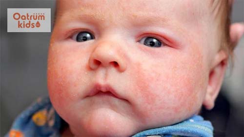 Lác sữa là một căn bệnh ngoài da