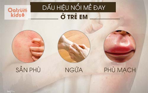 Dấu hiệu nổi mề đay ở trẻ là sần phù, mẩn ngứa tại nhiều vị trí trên cơ thể
