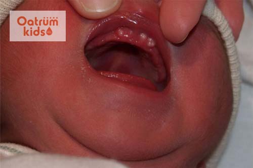  Nanh sữa thường xuất hiện ở niêm mạc lợi hàm trên và hàm dưới.