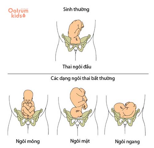  Ngôi thai thuận sẽ giúp mẹ sinh thường dễ dàng hơn.