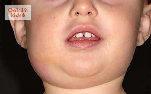  Quai bị là một bệnh dễ lây lan và có thể để lại biến chứng