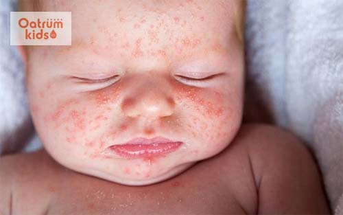  Trẻ sơ sinh bị bệnh viêm da dị ứng