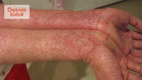  Biểu hiện của viêm da dị ứng trên tay