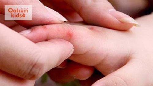  Những mụn ban đỏ là dấu hiệu đầu tiên của bệnh chân tay miệng