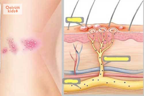  Nguyên nhân gây bệnh zona thần kinh